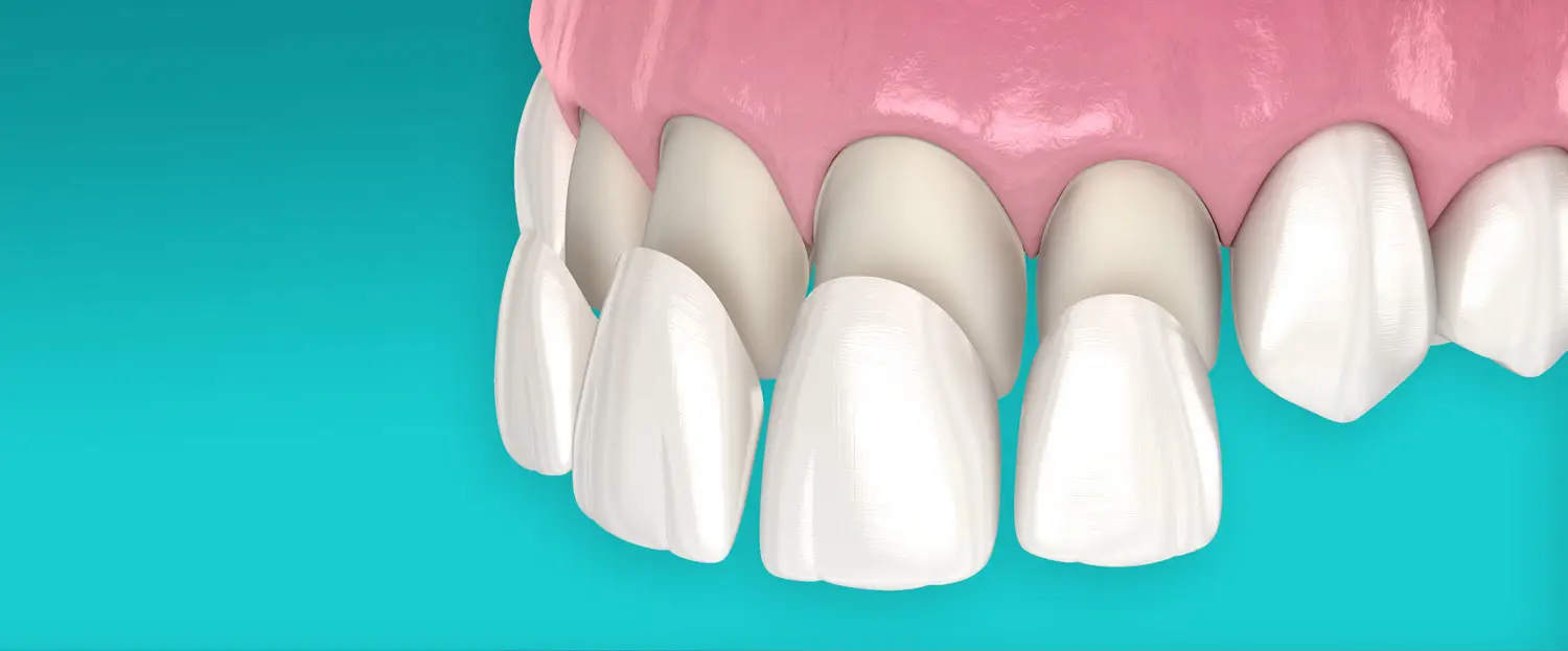 Hollywood-Smile Veneers