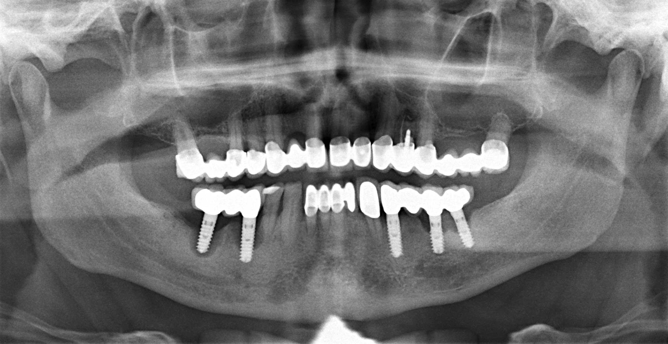 Periimplantitis